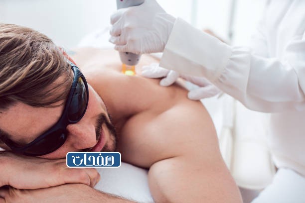 إزالة الشعر بالليزر للرجال
