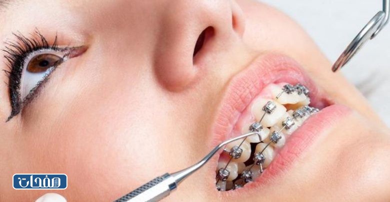 افضل دكتور تقويم اسنان بالرياض