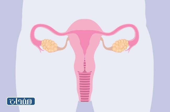 تجارب تكيس المبايض والحمل