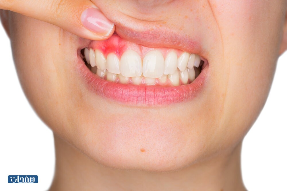 تجارب علاج خراج الأسنان