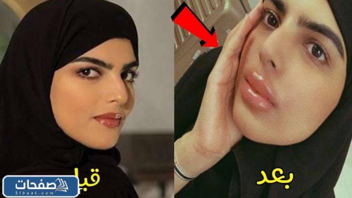 خشم نجلاء الودعاني قبل وبعد