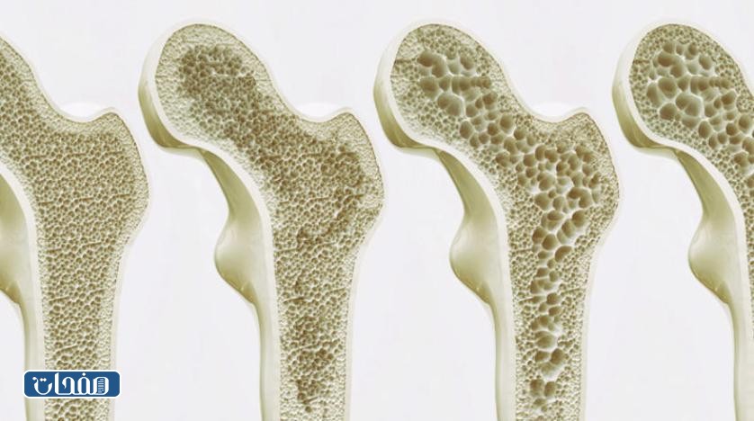 علاج هشاشة العظام بالاعشاب جابر القحطاني
