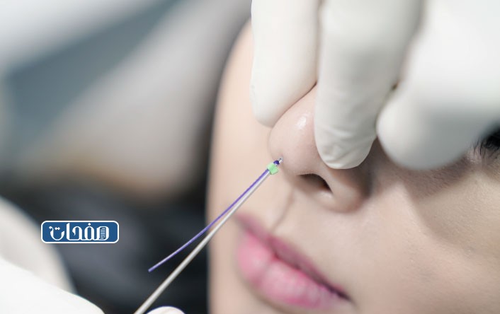 ما هي الخيوط التجميلية للأنف