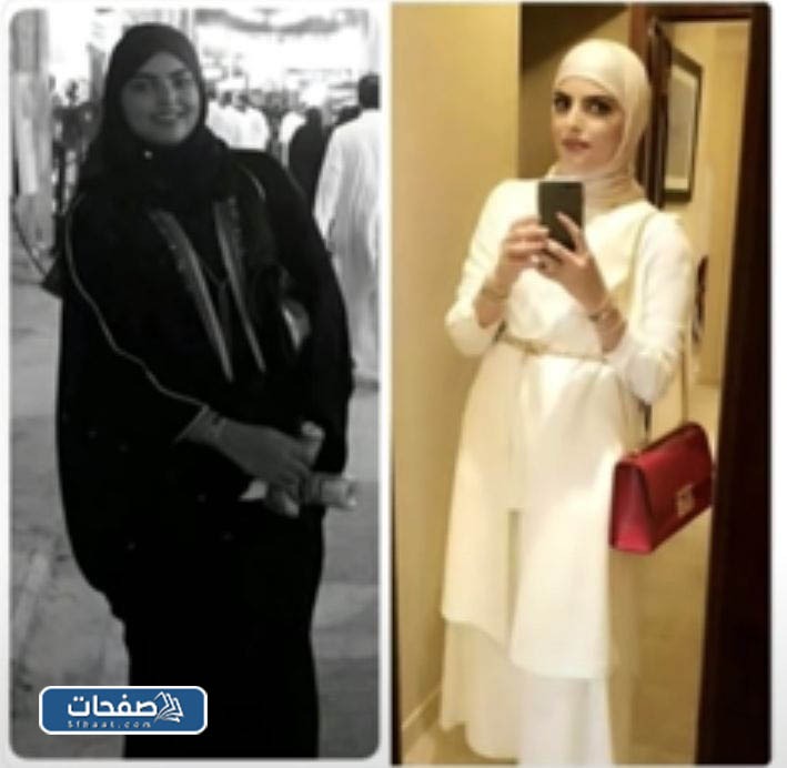 نجلاء الودعاني بعد التكميم