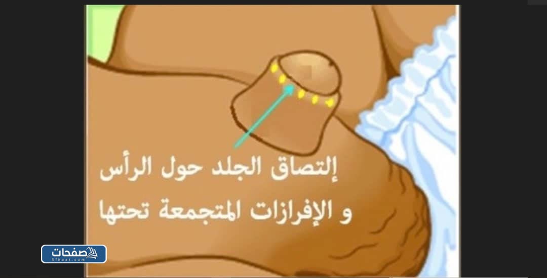 الختان الخاطئ