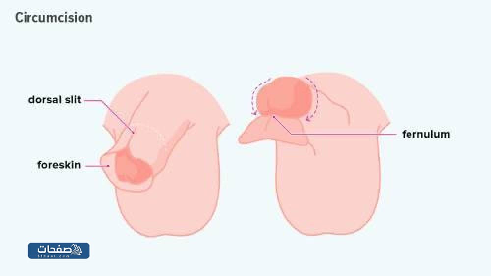 الختان الخاطئ للذكور