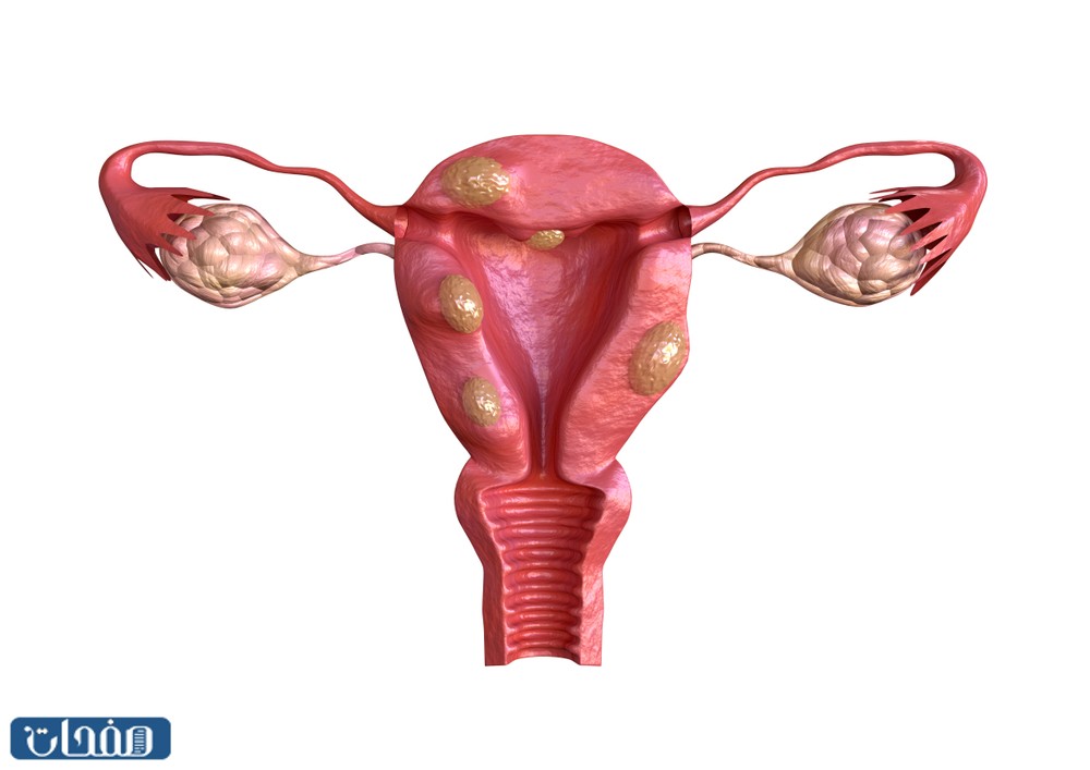 التجربة الثانية مع الورم الليفي