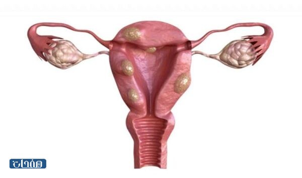 تجارب الحوامل مع الورم الليفي