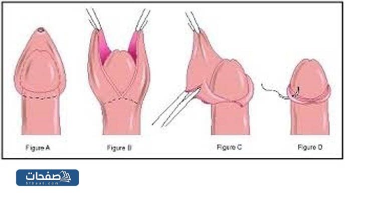 خطوات الختان
