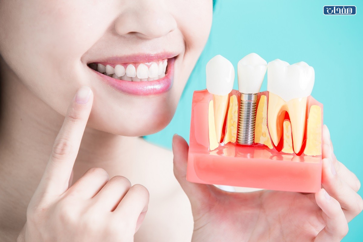 كم سعر زراعة السن الواحد في المهيدب