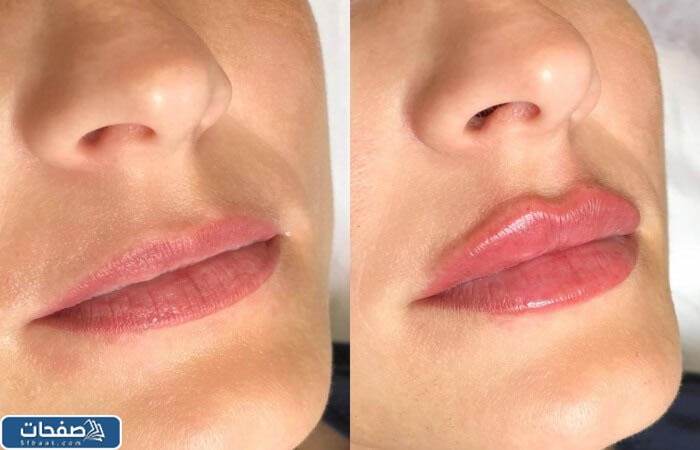 افضل انواع الفيلر للشفايف