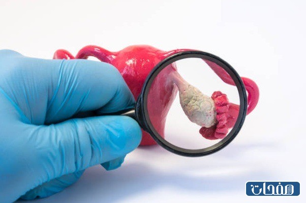 تجربتي مع كيس على المبيض